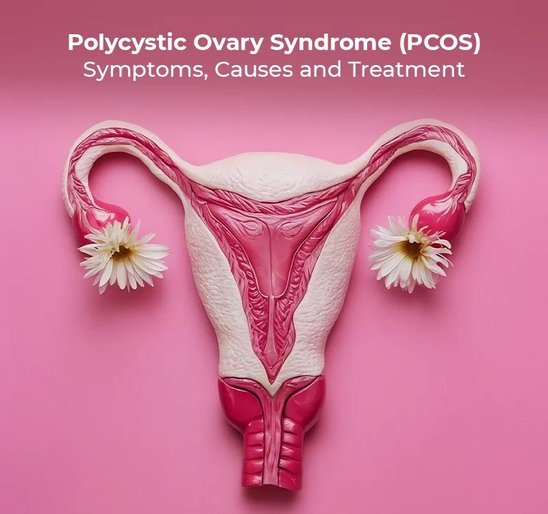 Polycystic Ovary Syndrome (PCOS): Symptoms, Causes and Treatment