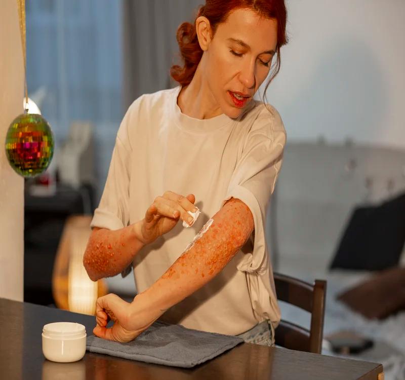 Treating Skin Rashes And Eczema Using Ayurvedic Remedies.