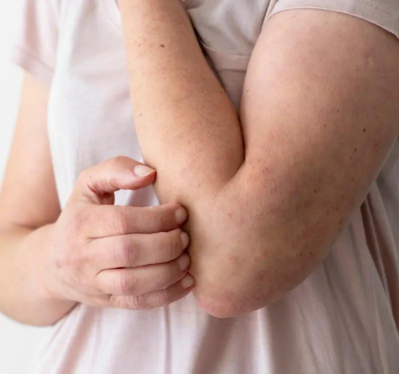 Understanding Urticartia: Signs, Causes & Why Urticaria Ayurvedic Treatment Is The Best!