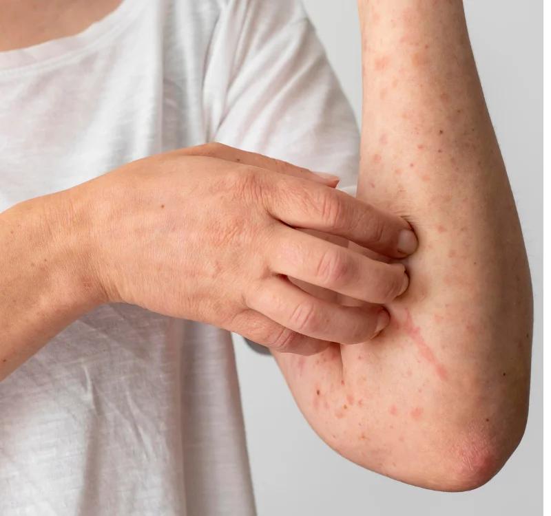 Here are the 5 Best Allergy Treatments in Ayurveda for Instant Relief