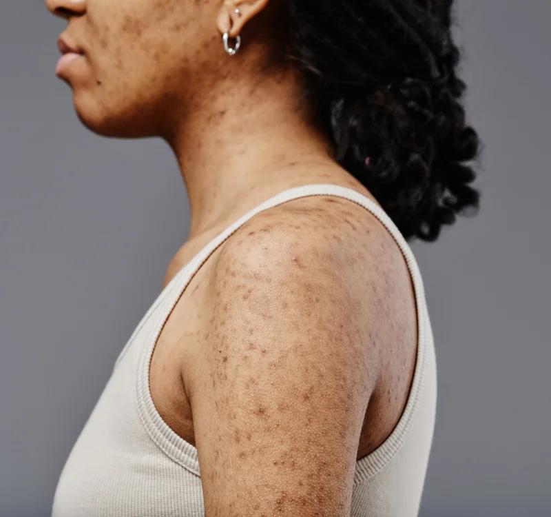 Simple and Effective Solutions For Ayurvedic Treatment for Hyperpigmentation