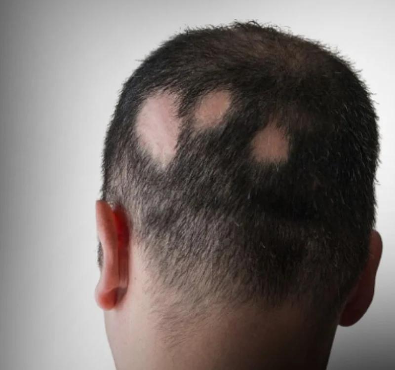 8 Effective Alopecia Areata Ayurvedic Treatment Options to Try
