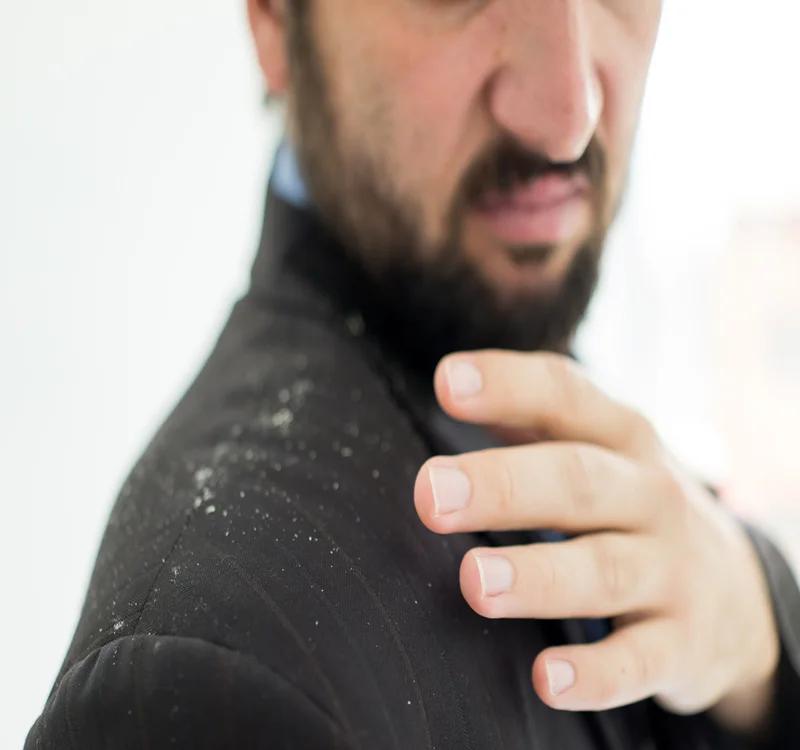 How to Control Dandruff Naturally